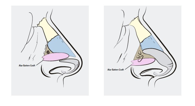 Batten grafts usually do not compromise nasal esthetics but do created slight fullness of the supra alar region.