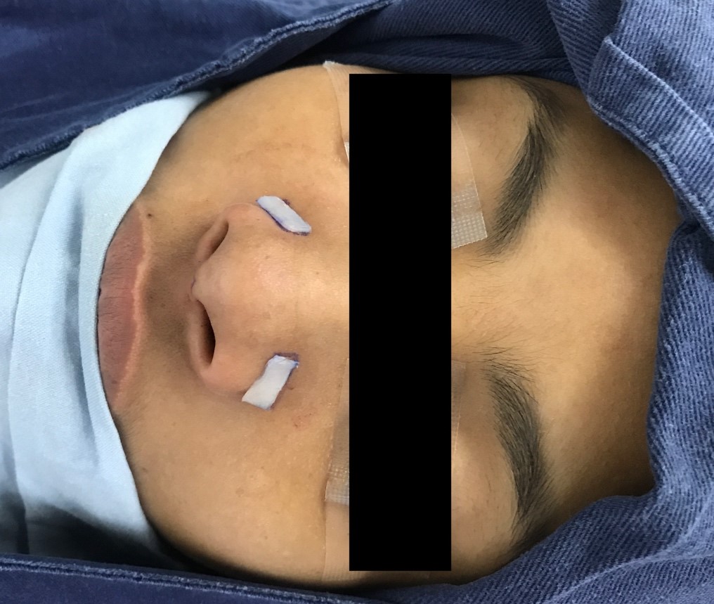 Intraoperative photograph of the planned position of insertion of the batten grafts on the scroll area bilaterally. Grafts were harvested from nasal septum.