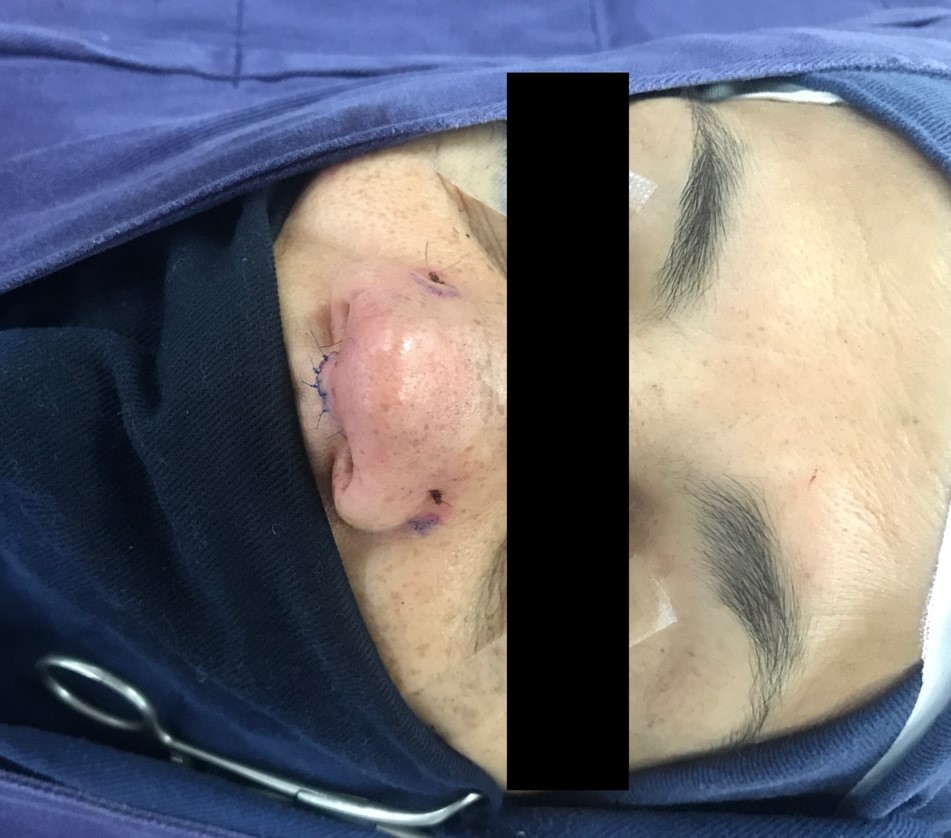 Intraoperative photograph of batten grafts positioned through external approach. Notice the sutures holding the grafts in place.