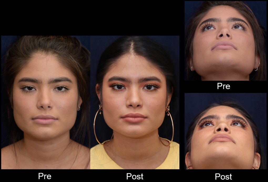 Figure 3: Pre/post rhinoplasty at f/9 (pre-op with 1/100 s, f / 9.0, ISO 720, 105 mm, full frame; postoperative with 1/50 s,f / 9.0, ISO 800, 60 mm, crop frame) Note eyes are in sharp focus.