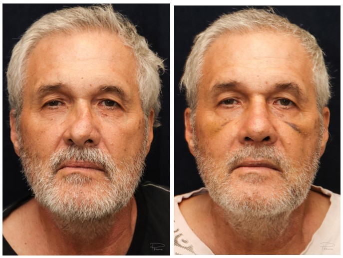 Figure 4: Pre/post pictures of patient who underwent septorhinoplasty with osteotomies, costal cartilage graft, temporalis fascia graft. Note eyes are not in focus.