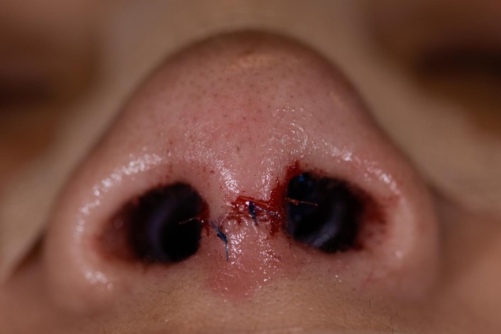 Figure 5: Intraop rhinoplasty photography at f/2.8 with shallow depth of field.