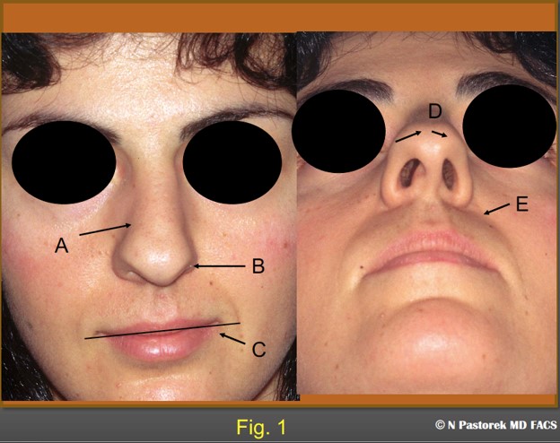 Figure 1. This is the index rhinoplasty case who presented with the additional facial surface findings of a hypoplastic maxilla. A) nose deviated to the left, B) ipsilateral elevated alar attachment, C) elevated oral commissure, D) deviated nasal tip, E) ipsilateral deep oral commissure.