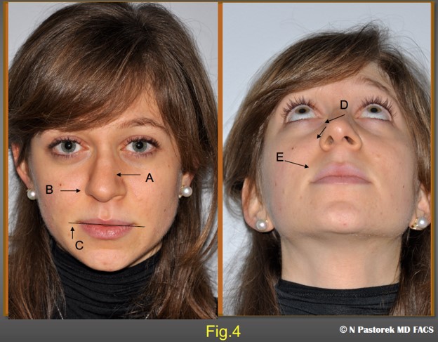 Figure 4. Findings in a patient presenting for rhinoplasty who can benefit for the Sub Alar Graft. (A) The entire nose is deviated to the affected side. (B) The alar base attachment is elevated 2-3 mm compared to the opposite side and the ipsilateral ala is hidden on the frontal view, (C) The oral commissure is elevated. (D) A relatively symmetric tip is rotated toward the affected side. (E) The nasolabial sulcus is deeper on the affected side.