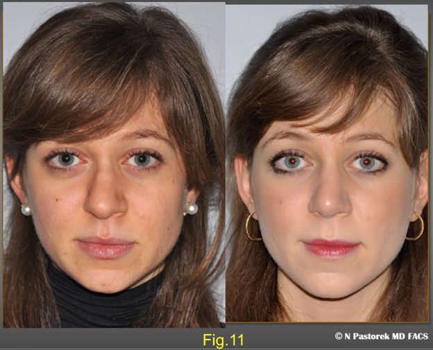 Figure 11. Preoperative and postoperative frontal views of the patient at one year. The significance of the Sub Alar Graft is most obvious in this view. The nose is straighter. The elevated alar margin is now lower and symmetric with the unaffected side. The oral commissure is lowered making the plane of the lips more horizontal.