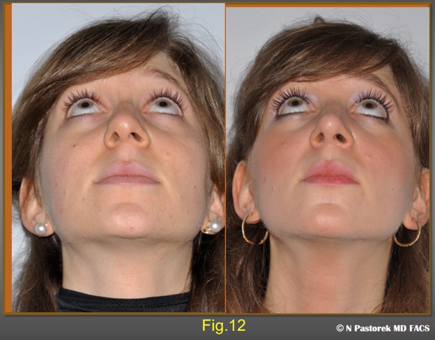 Figure 12. Preoperative and postoperative submental views of the patient at one year, The Sub Alar Graft has helped to rotate the nasal toward a more central position. The nasolabial sulcus is more symmetric with the opposite side.