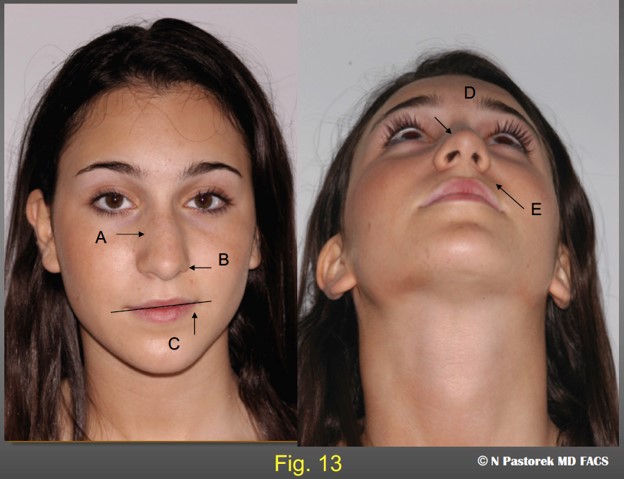 Figure 13. A 21year old patient presenting for rhinoplasty. The common elements seen of the physical examination suggesting that a subalar graft could improve the overall results of the rhinoplasty are. A) deviated nose to the left, B) an elevated left nasal ala, C) an elevated oral commissure, (D a relatively normal nasal tip rotated to the left, E) a deep nasal labial sulcus.