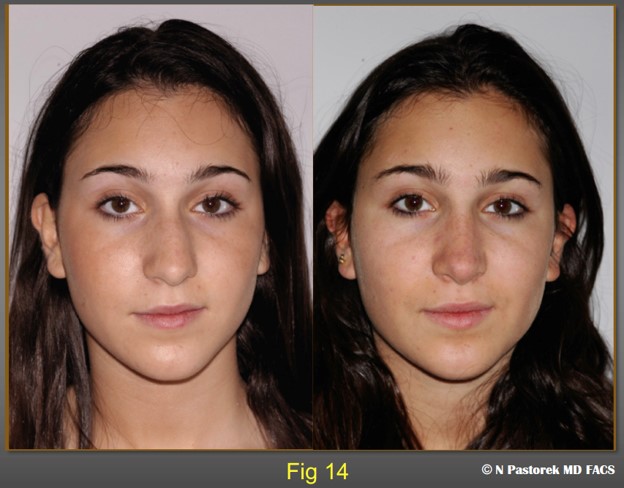 Figure 14. At one year postop this patient shows the degrees of improvement of a subalar graft in a rhinoplasty patient with a hypoplastic maxilla. Some improvement is always obtained. The patient is advised that the subalar graft is not usual in rhinoplasty cases. It is being use to lessen the surface effects of a hypoplastic maxilla. In this case the nasal tip is more centralized postoperatively, the alar sill attachment has been lowered, the oral commissure is lower and the nasal labial sulcus has been elevated.