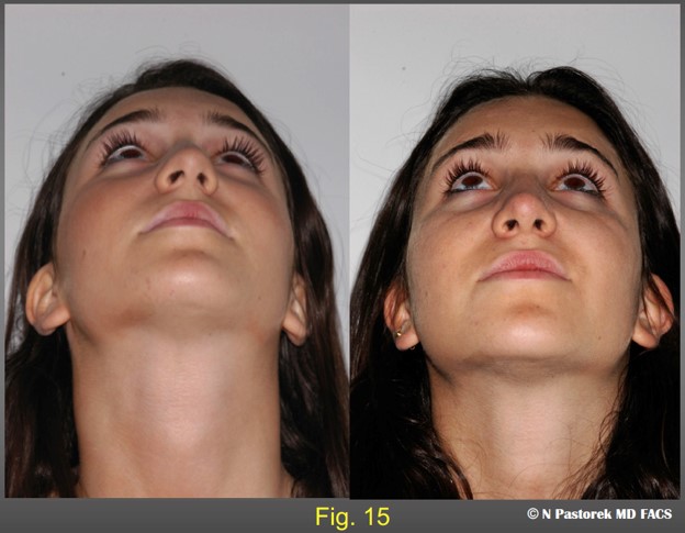 Figure 15. The nasal tip has been rotated to the center face. Straightening the caudal septum is imperative, but the subalar graft aids is rotating the nasal tip. The nasolabial sulci are more symmetric.