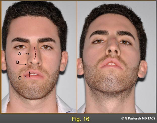 Figure 16 A traumatic nasal deformity in a 23 year old patient. The frontal view shows, A) nasal bone fracture and a possible upper lateral cartilage avulsion. He has additional pre -existing findings, B) elevated alar sill attachment on the right and a deep nasal labial sulcus. and C) an elevated right upper lip with poor lip closure. Though this is not a classic patient for the subalar graft he was considered a candidate for the procedure in addition to an open reduction of a nasal bone fracture and right upper lateral cartilage grafting.