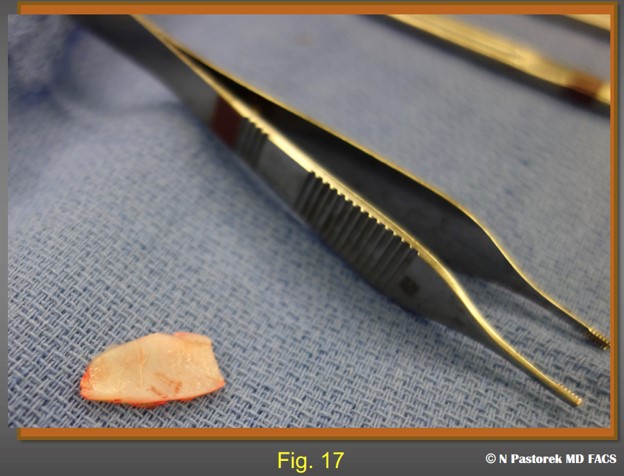 Figure 17. A septal cartilage segment for subalar grafting measuring approximately 3cm x 1.5 cm.