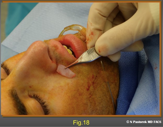 Figure 18. The position and relative size of the subalar graft is shown.