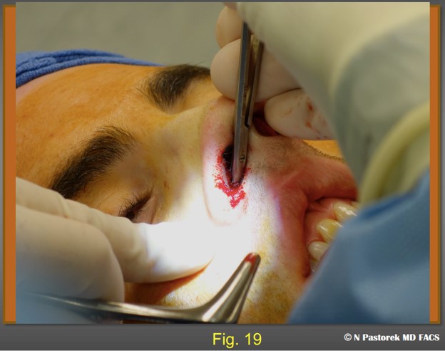 Figure 19 . The dissection into the canine fossa through the osteotomy incision at the pyriform fossa with a Stevens scissors is shown. Care is taken not to close the Stevens scissors completely while doing the dissection. The facial artery is in vicinity and must be protected.