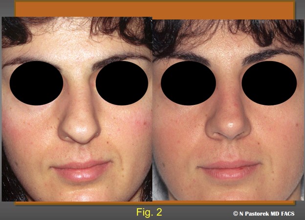 Figure 2. The preoperative and postoperative views of the patient at one year following rhinoplasty. Note the effects of the subalar graft. The nasal tip is rotated to the central position. The left alar attachment is now at the same level as the opposite side. The oral commissure on the left is now lower. The deep nasal labial sulcus is similar to the opposite side.