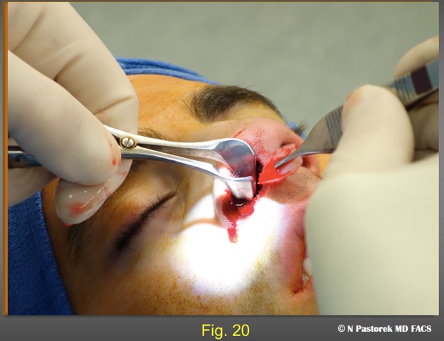 Figure 20 The subalar graft is being placed. The pocket should be slightly smaller than the graft so is held in place and does not float about once it is placed.