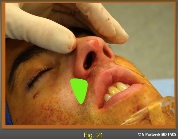 Figure 21 The diagram shows the final position of the subalar graft.