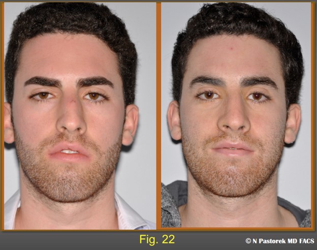 Figure 22 This pre- and post operative photo shows the effect of the subalar graft. The alar sill attachment has been lowered. The right lateral upper  lip has been lowered so that there is a lip seal in repose.