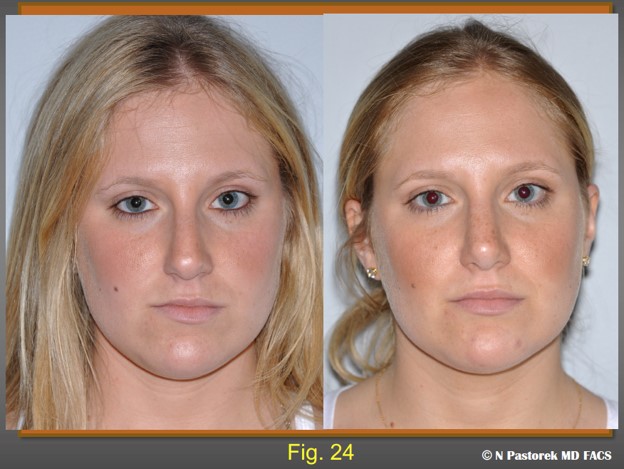 Figure 24. Pre- and Postoperative frontal views of the patient at one year. The effects of the subalar graft can be seen. The dorsum is midline, the alar sill attachments are symmetric, the nasal tip in centralized. And the right oral commissure has been lowered.