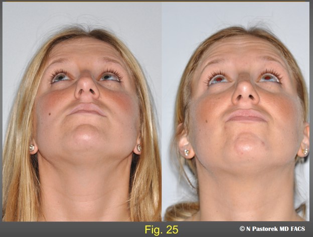 Figure 25. Pre- and postoperative submental views of the patient central positioning of the nasal tip and more symmetric nasolabial sulci.