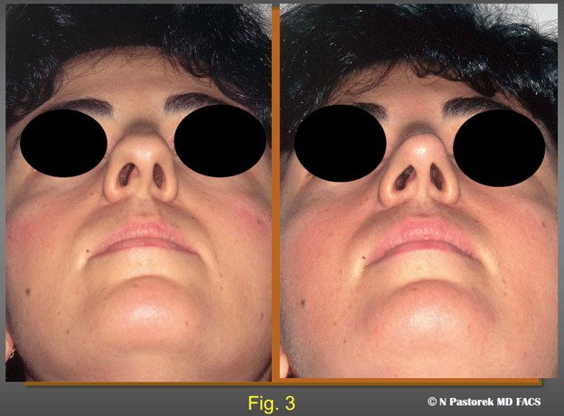 Figure 3. The pre- and postoperative submental views of index patient at one year post op. The boxy tip which was rotated to the right affected side is now more triangular in shape and positioned more centrally.