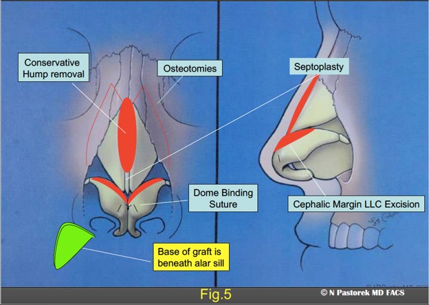 Figure 5. The graphic illustration shows the procedures of the rhinoplasty in this patient. The Sub Alar Graft is positioned at the conclusion of the procedure so the base of the triangular graft is beneath the elevated ala.