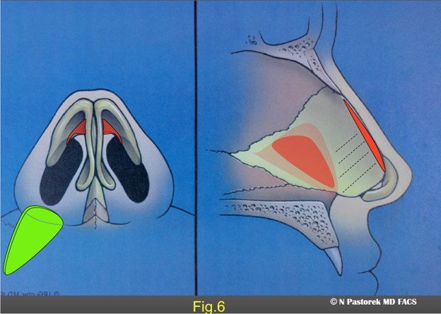 Figure 6. Base view illustration showing the positioning of the Sub Alar Graft beneath the elevated ala.