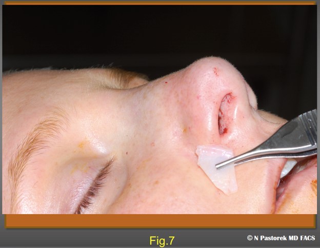 Figure 7. This figure shows the size and position of a Sub Alar Graft which will placed in dissected pocket over the periosteum of the canine fossa