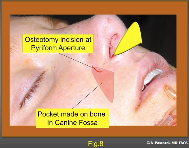 Figure 8. This figure illustrates the size and position of the dissection over the canine fossa periosteum via the incision made for a lateral osteotomy. The mucosal incision can be enlarged slightly but not much. There is an advantage in just slightly stretching the incision so that when the graft is placed the incision contracts over the graft.