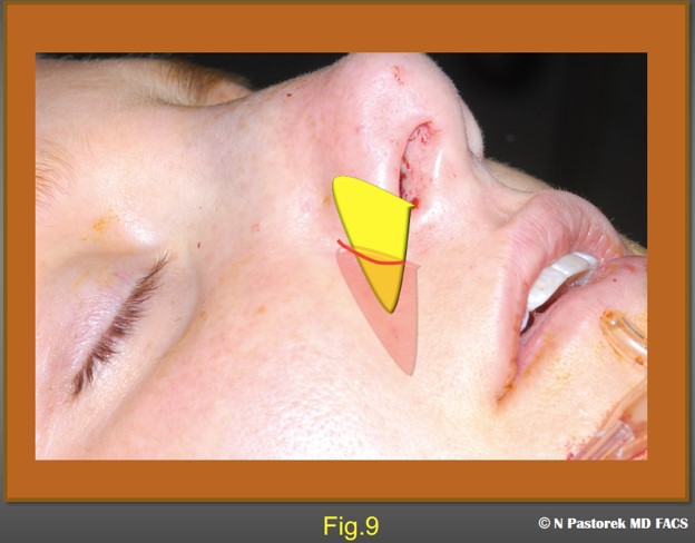 Figure 9. This illustration shows the osteotomy incision being stretched to accommodate the Sub Alar Graft which is larger than the incision.