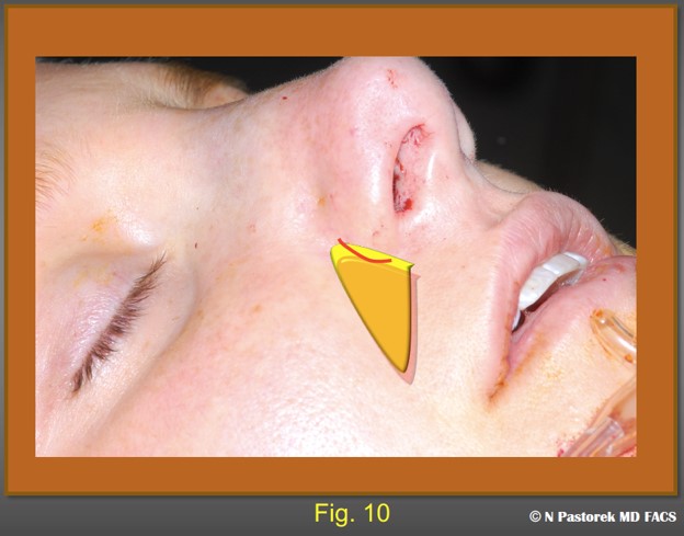 Figure 10. This illustration shows final ideal position of the graft with the base showing at the osteotomy incision. Usually, a single 4-0 chromic suture is used to close this incision to prevent the graft from migrating.