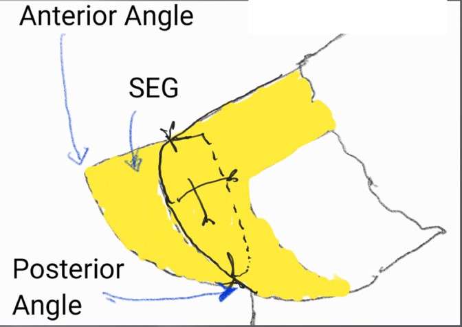 Figure 1. Septal Extension Graft, side to side