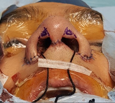 Figure 10a. A piece of triangular skin tissue in the subtip area is excised following the imaginary border of the ala and the columella. Make sure to leave a 1.0-1.5mm of rim margin to prevent notching.