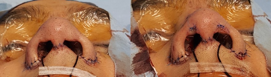 Figure 10b. Before and immediately after excision.