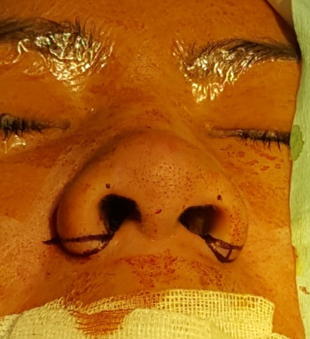 Figure 11a. Alar flare to be corrected via wedge excision only. Note the small nasal sill.