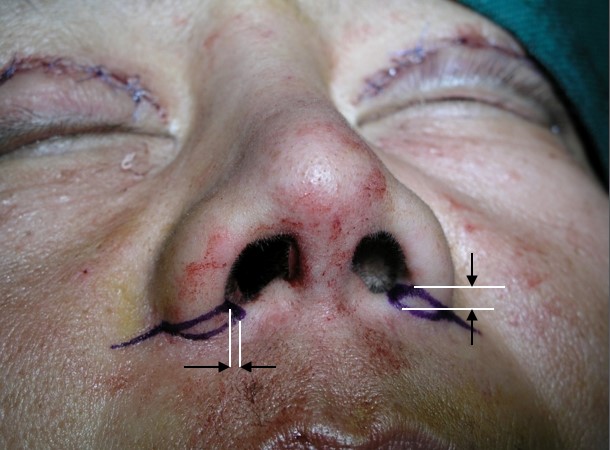 Figure 11b. A two-dimensional analysis of alar base and flare. Correction is via combined excision.