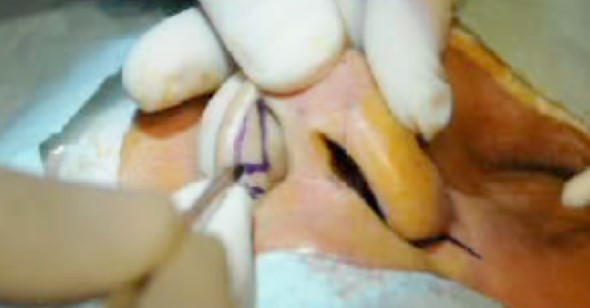 Figure 12a. Sail Excision for alar lift. The skin together with the subcutaneous fats and muscles are removed and the alar rim is flipped inwards as a flap.