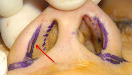 Figure 12b. The vestibular groove should not be mistaken as the caudal margin of the lower lateral cartilage.