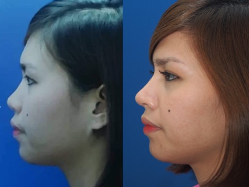 Figure 13c. Preop postop. Lateral view. Note the improvement in tip counterrotation and projection, columellar show, alar rim, premaxilla and nasal dorsum.