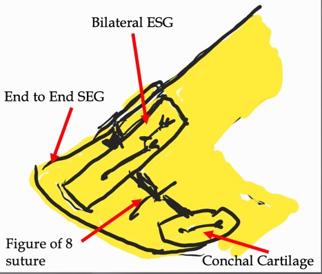 Figure 2. Septal Extension Graft, end to end