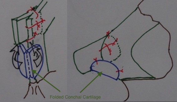 Figure 4. Folded conchal cartilage placed as sandwich support below the SEG.
