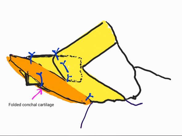 Figure 5. A long folded conchal cartilage with a slit is interposed with the SEG.