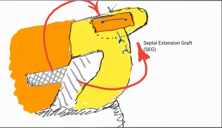 Figure 7. Bony septum as support for weak septum