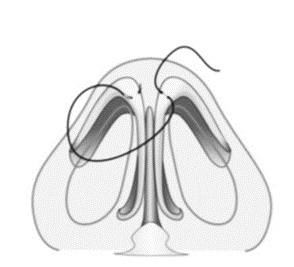 Interdomal suture, image 2
