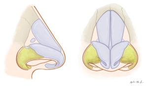 Tip Rhinoplasty: Alar Structural Support Techniques