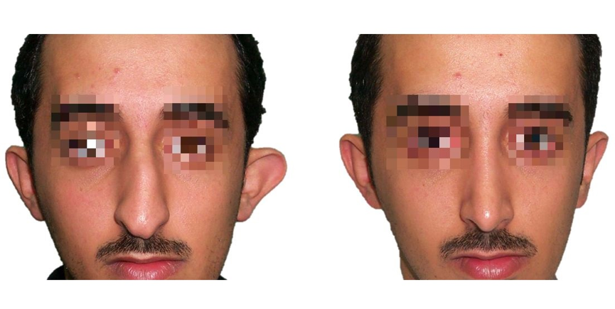 Figure 11 A: Pre- and post-operative frontal view photos