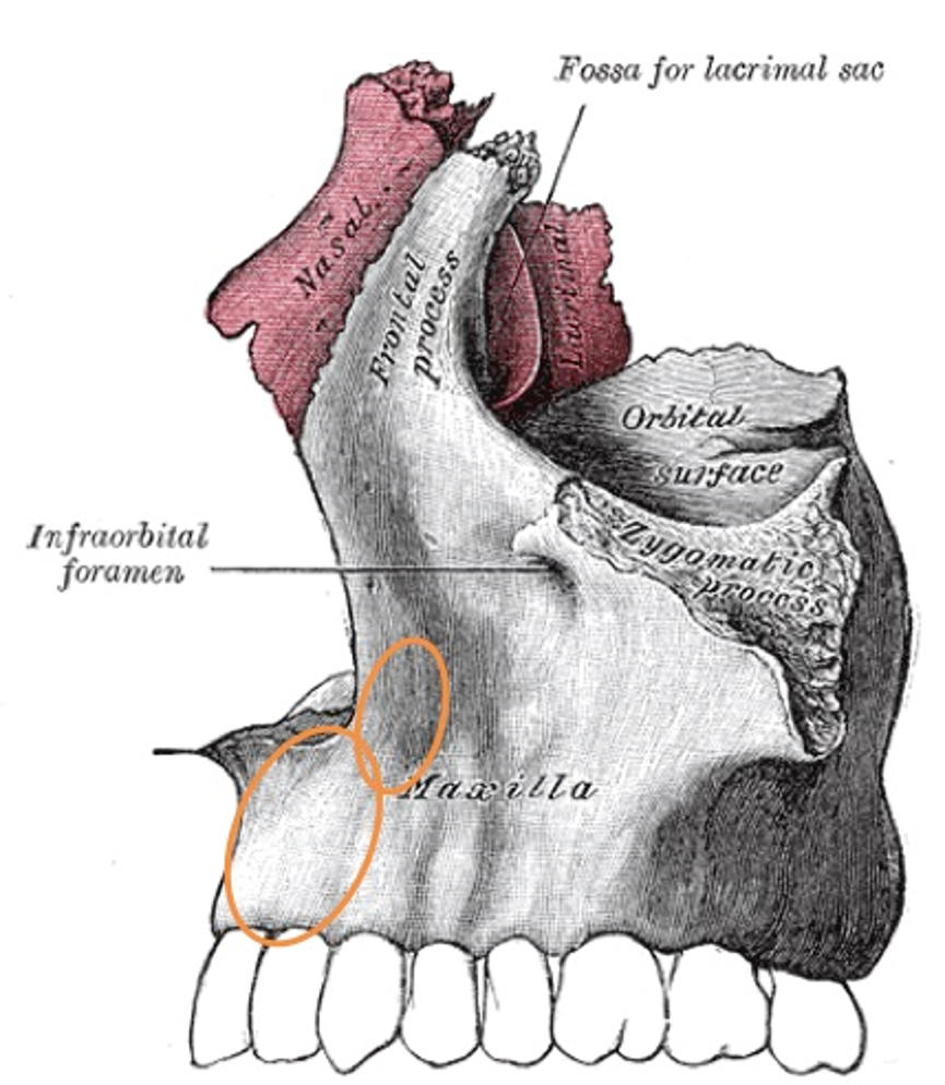 Figure 1. Lateral view of the left bony maxilla9. The orange ovals highlight the areas of bony deficiency, leading to premaxillary and perialar retrusions.