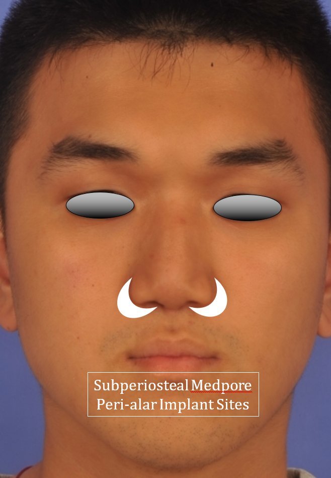 Figure 3. Shapes and sites of peri-alar Medpor implants