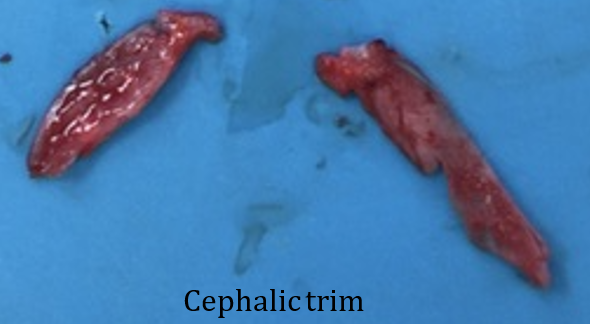 Figure 5. Resected cephalic borders of the bilateral upper lateral cartilages