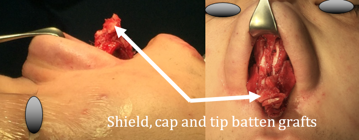 Figure 6. Shield graft to address columella retraction, and cap and tip grafts to project and define the tip.