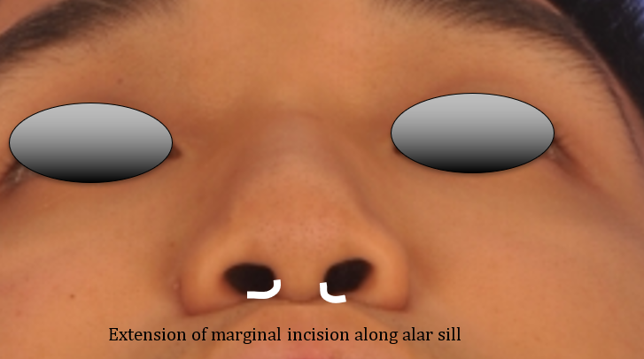 Figure 8. Extension of marginal incision along alar sill to create a columellar advancement flap for closure of columella incison with minimal tension.